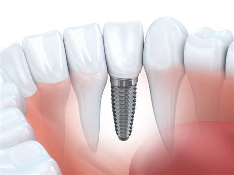 Implantes Clínica Dental Fernando Gala