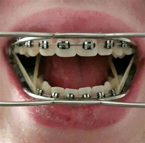 Braces Girlswithbraces Metalbraces Headgear Tipos De Aparelho Aparelho Ortodontico
