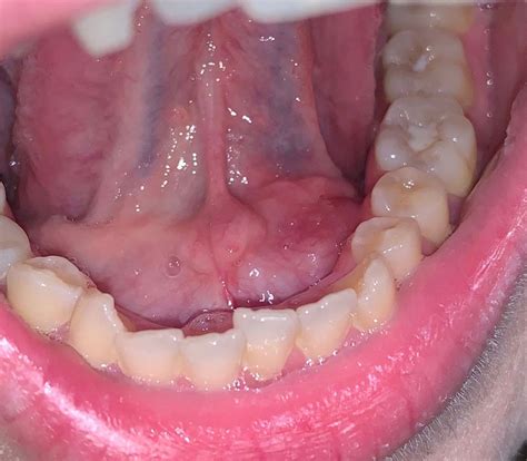 Swelling On Floor Of Mouth Under Tongue Treatment