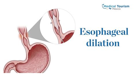 Esophageal Dilation Medical Tourism Mexico Youtube