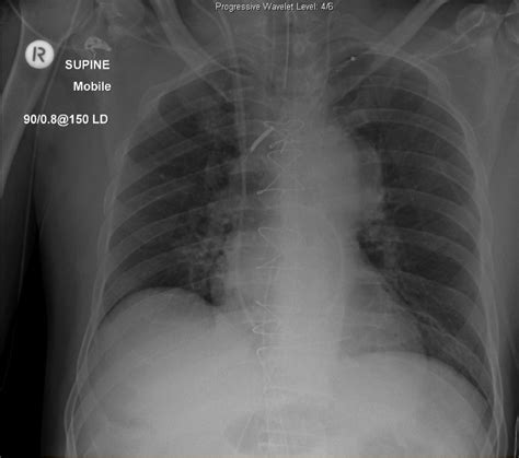 A Chest Radiograph After Cardiac Surgery Intensive