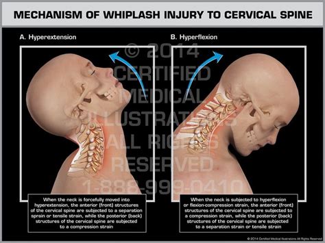 Mechanism Of Whiplash Injury To Cervical Spine Male Print Quality