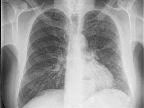 Left Lower Lobe Pneumonia Chest X Ray