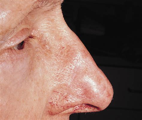 The Forehead Flap For Nasal Reconstruction Facial Plastic Surgery