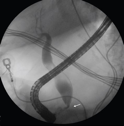 Wire Basket Sweep Ercp Bile Duct