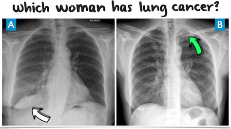 Can Lung Cancer Be Found On A Chest X Ray Cancerwalls