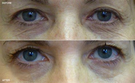 Why You Will Love Pellevé A New Lower Eyelid Skin Tightening Treatment