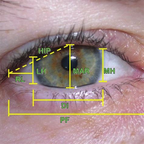 Standardized Eye Measures Di Horizontal Diameter Of The Iris Mar