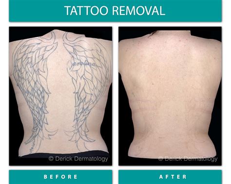 Tattoo Removal Laser Chicago Picosure Derick Dermatology