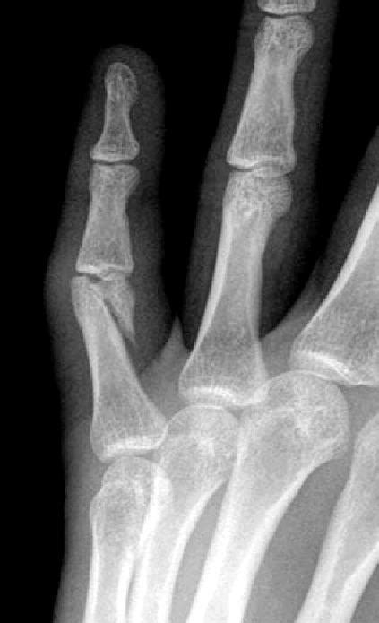 Unstable Phalangeal Fractures Treatment By Ao Screw And Plate