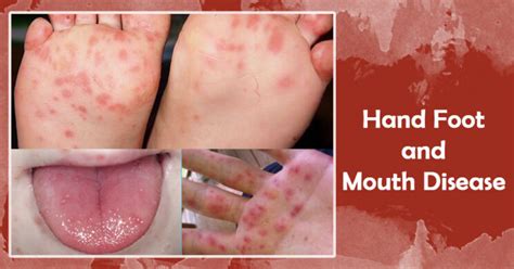 Hand Foot And Mouth Disease Sri Lanka College Of Microbiologists