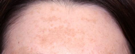 Skin Brown Spot Treatments Body And Face Murfreesboro Tn