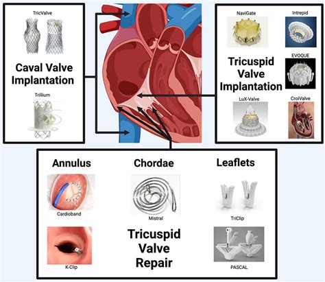 The Current Landscape Of Transcatheter Tricuspid Valve Intervention
