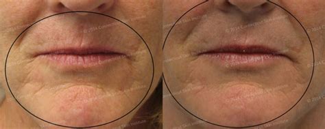 Skin Tightening Of Wrinkles Around Mouth Connecticut Skin Institute
