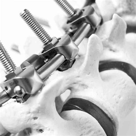 Thoraco Lumbar Osteosynthesis Unit Ses Neuro France Implants