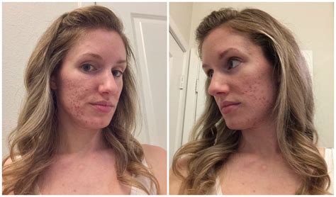 How I Cleared My Acne And Improved My Acne Scars Bekahbee