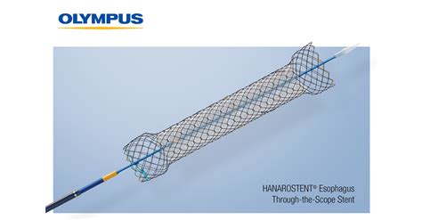 Olympus Adds Hanarostent Esophagus Through The Scope Stent To Its