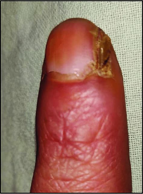 Acquired Periungual Fibrokeratoma Complication Of Acute Paronychia