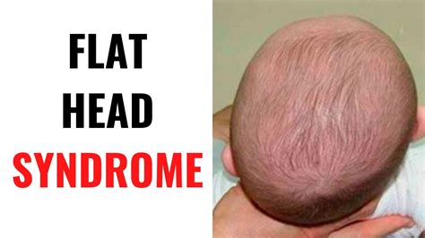 Flat Head Syndrome Symptoms Causes Prevention Youtube