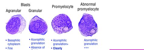 Blasts Promyelocytes Abnormal Promyelocytes Download Scientific