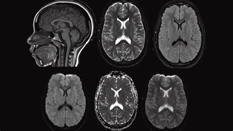 Stroke Vs Normal Brain Mri Mri Shows Brain Scars In Military