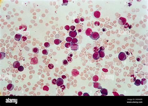 Light Micrograph Of Bone Marrow Cells Showing Precursor Red Faint Red