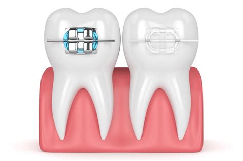 My Wisdom Teeth Stitches Came Out After 4 Days Why Recovery Care