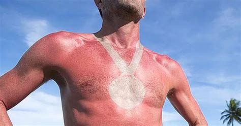 Risk Of Skin Cancer From Summer Day Game Sunburn Tattoo