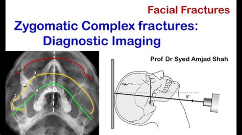 Diagnostic Imaging For Zygomatic Complex Fractures Oral