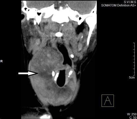 Thyrolipomatosis An Inquisitive Rare Entity Sanuvada Gland Surgery