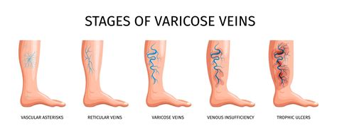 Anatomy And Function Of Superficial Veins And Common Disorders