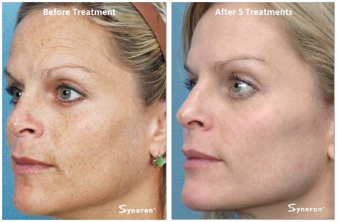 Ipl Face Treatment Before After Doctor Heck