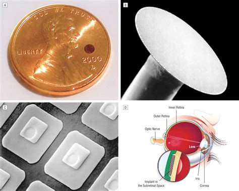 The Artificial Silicon Retina Microchip for the Treatment of VisionLoss ...