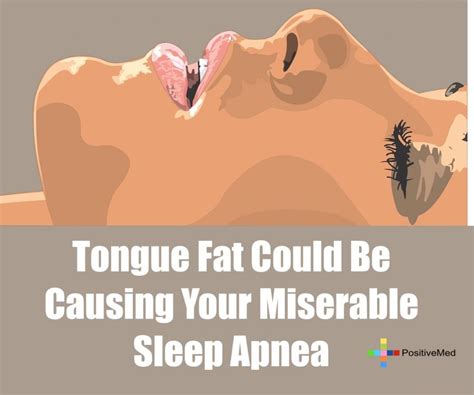 Tongue Fat Could Be Causing Your Miserable Sleep Apnea