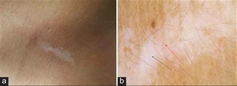 A And B Depigmented Macule On The Anterior Part Of The Neck