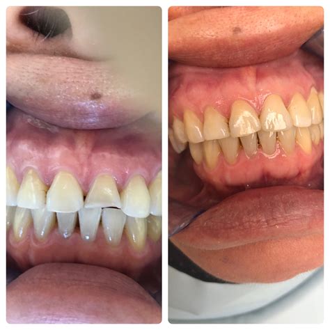 Before & After - Rockville Dental Care