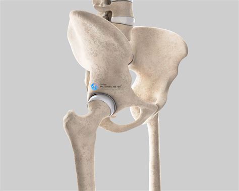 Minimally Invasive Anterior Approach Total Hip Replacement Doctor