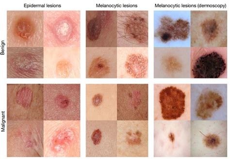 Research Have Discovered That Squamous Cell Skin Cancers Do Not Require