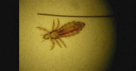 Washington Lice Grow Resistant To Common Treatments