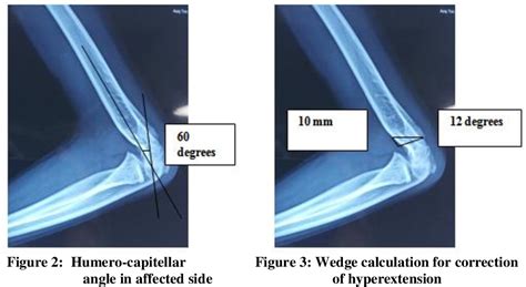 Figure 2 From Fixation Of Supracondylar Osteotomy Of The Humerus For