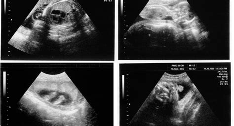 Ultrasound During Pregnancy How Its Done And What You Learn Babycenter