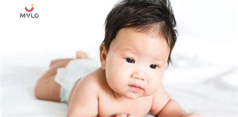 Boils In Babies Treatment And Home Remedies
