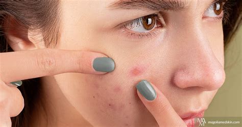 How To Treat Embarrassing Acne Magnolia Medical And Aesthetics