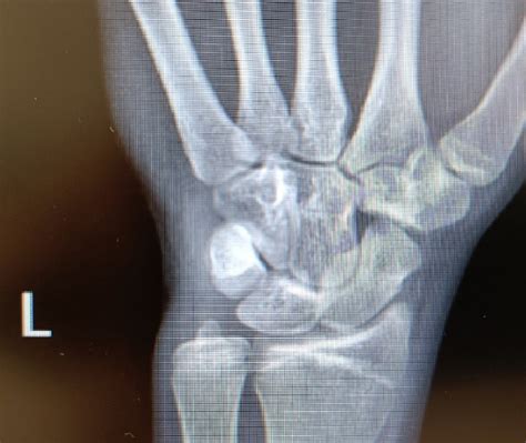 Left Wrist X Ray For Patient 1 Enhanced Download Scientific Diagram