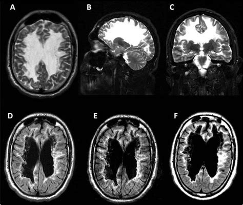 Vanishing White Matter Disease A Case Of Severe Adult Onset With
