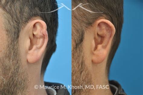 New York Cauliflower Ear Treatment Causes Symptoms