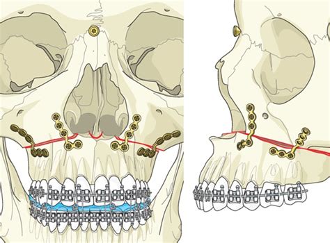 Ostéotomie Mandibulaire
