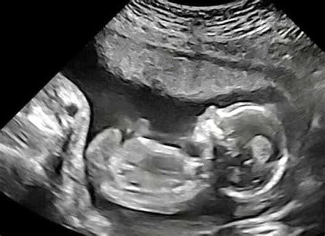 Ultrasound Clinic Fails To Identify Unborn S Fatal Condition And Got Gender Wrong Mirror Online