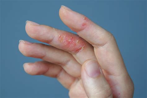 Atopic Hand Dermatitis Eczema On The Fingers Stock Photo Download