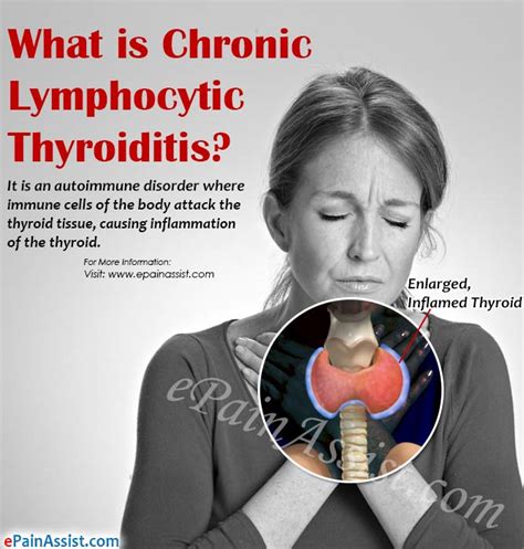 What Is Chronic Lymphocytic Thyroiditis And How Is It Treated Causes